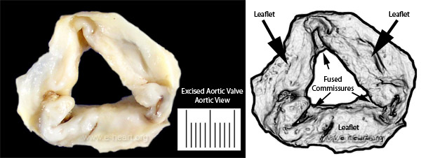 Rheumatic Aortic Valve
